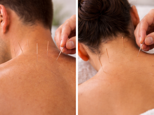 Acupuncture in Bournemouth at SoCo Therapies - A Calming Path to Wellbeing