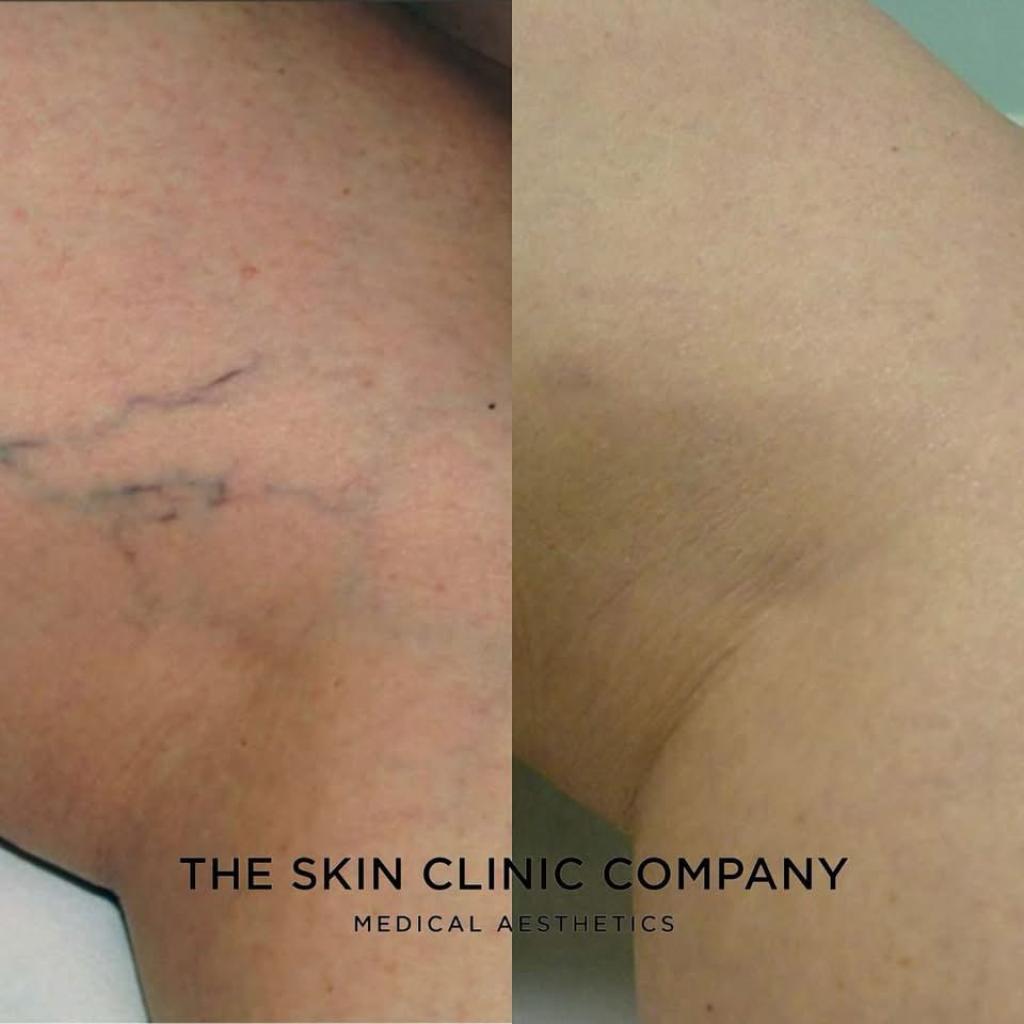 Advanced Laser Treatments at the Skin Clinic Company