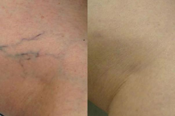 Advanced Laser Treatments at the Skin Clinic Company