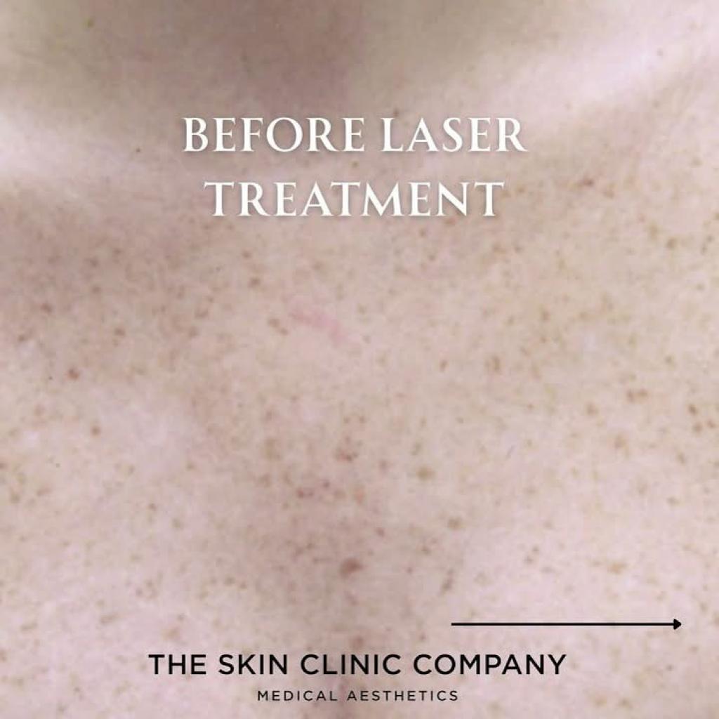 Advanced Laser Treatments at the Skin Clinic Company
