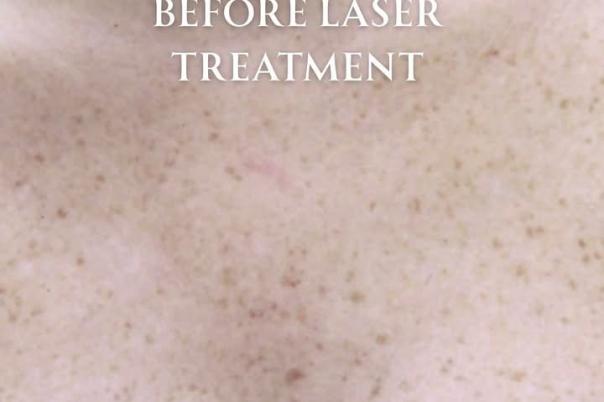 Advanced Laser Treatments at the Skin Clinic Company