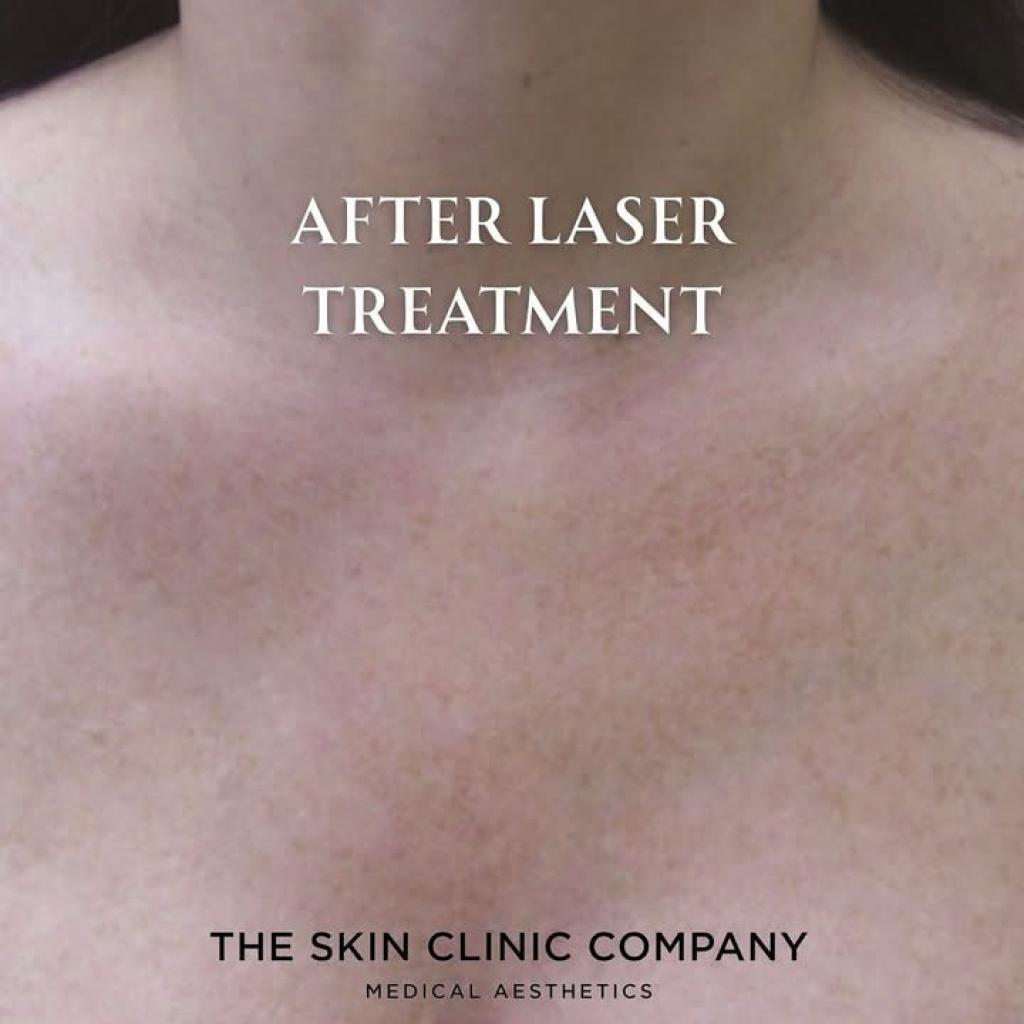 Advanced Laser Treatments at the Skin Clinic Company