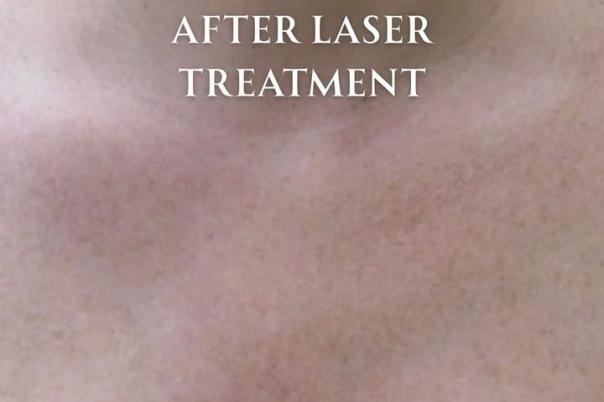 Advanced Laser Treatments at the Skin Clinic Company
